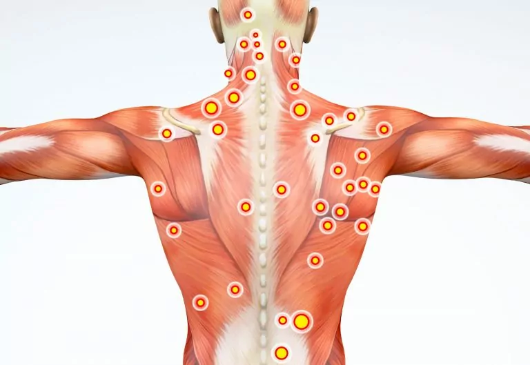 diagram of trigger points on the back body. what are trigger points?