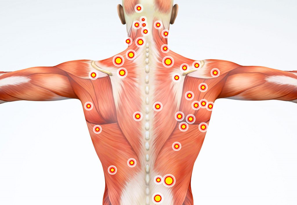 What Exactly are Trigger Points? Photo - Swedish Institute - New York, NY trigger point massage therapy