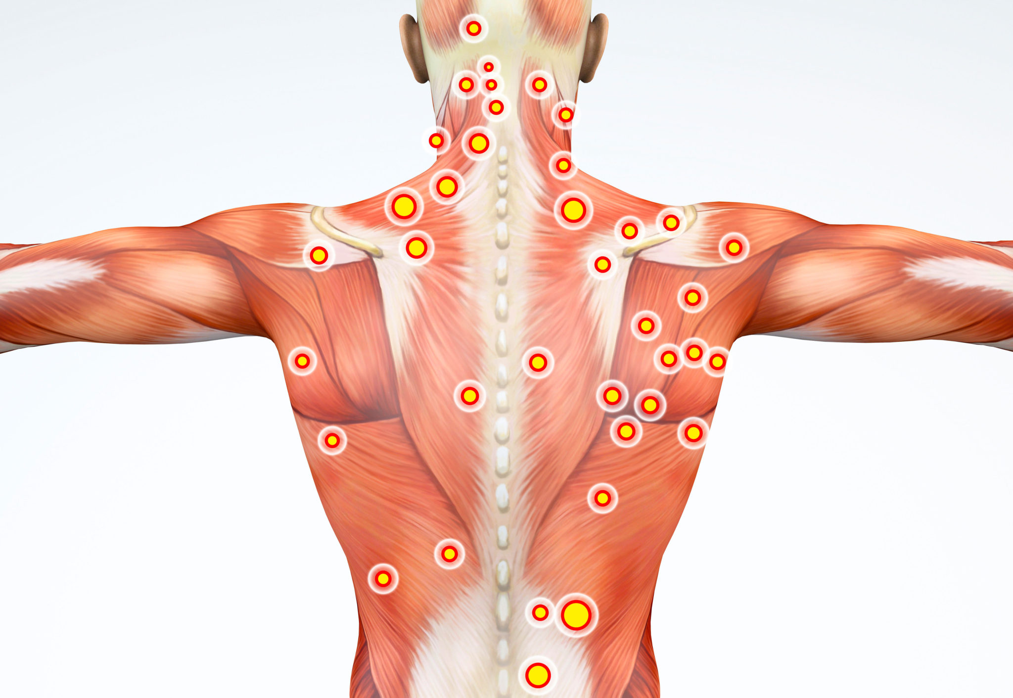 What are Trigger Points?